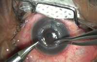 keratoplasty