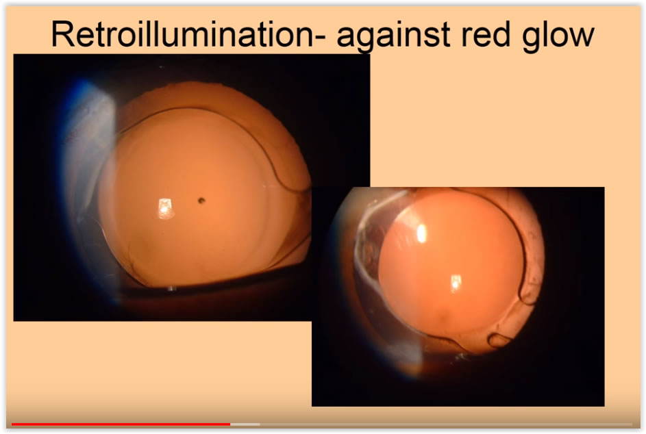 Slit Lamp examination  of the anterior segment